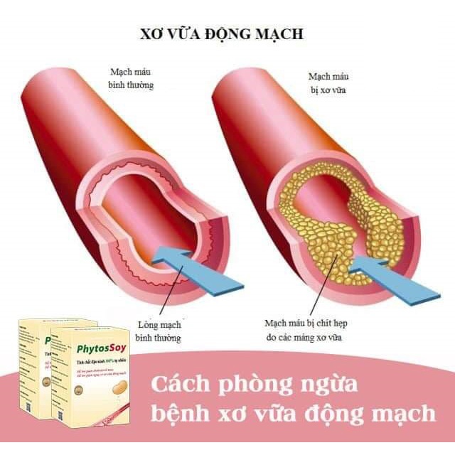 Phytossoy, Giảm cholesterol máu, điều hòa mỡ máu, ngừa tai biến, sản phẩm Viện Hàn Lâm