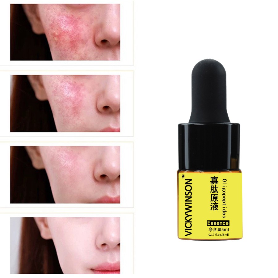 Tinh Chất oligopeptide 5ml Làm Trắng Giảm Mụn Và Se Khít Lỗ Chân Lông