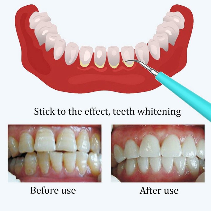 Dụng Cụ Lấy Cao Răng - Máy Lấy Cao Răng Tại Nhà Cao Cấp - Lấy Cao Răng Hiệu Quả