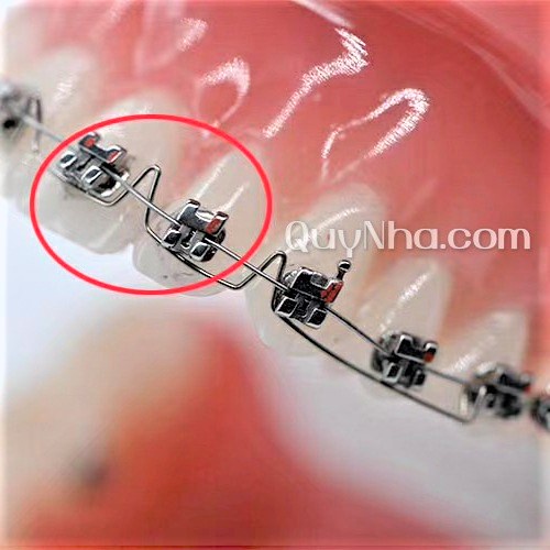 Lò xo Torquing ART Auxiliary