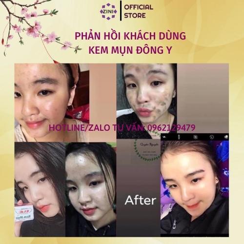 Kem mụn hoa đào đông y ZINI STORE, kem chấm mụn trắng da, mờ thâm, sạch nám