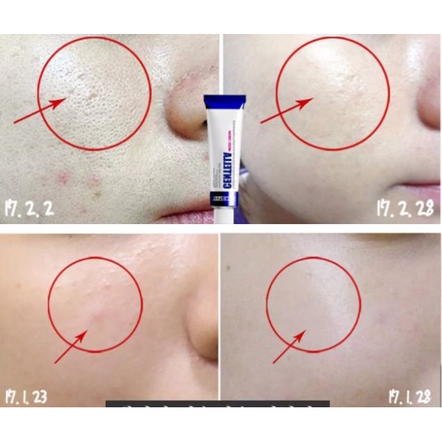 Kem Dưỡng Phục Hồi Chuyên Sâu Cho Da Mụn Medi-Peel Centella Mezzo Cream 30ml