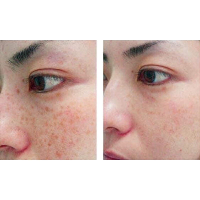 Vỉ Cao nám whoo radiant white ultimate corrector