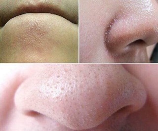 Máy hút mụn