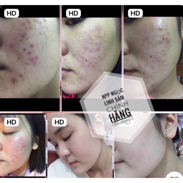 SERUM NGỌC LINH SÂM (MỤN-NÁM-TÀN NHANG -SẸO RỖ