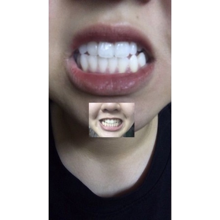 [FREE SHIP] Miếng Dán Trắng Răng 3D Crest Xịn