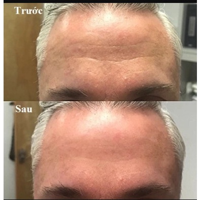 [DATE 05/22] Tinh chất vàng 24k Protein Peptide và chỉ căng cơ Protein Nano SARADOR GOLD PROTEIN PEPTIDE (Nhât)