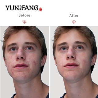 Mặt nạ bùn non Yunifang