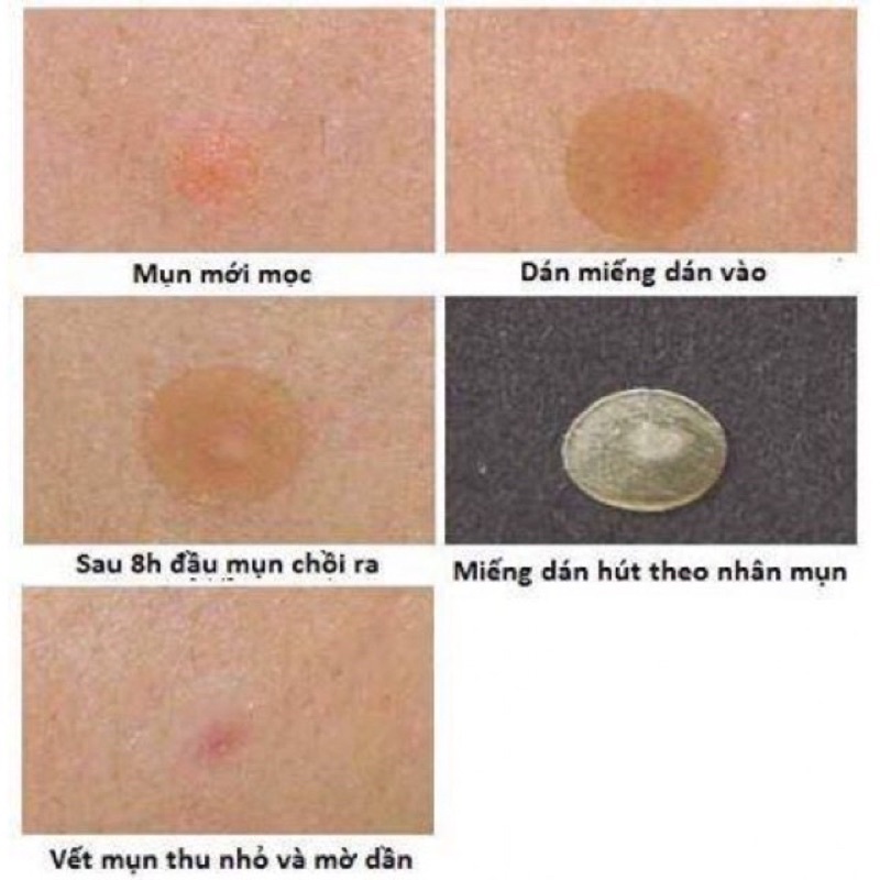 miếng dán hút nhân mủ mụn Mayan | BigBuy360 - bigbuy360.vn
