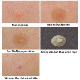 miếng dán hút nhân mủ mụn Mayan