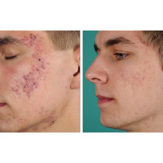[Quinshop.vn] Kem Trị Mụn Shiseido Pimplit Acne Remedy