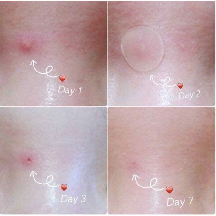 Miếng Dán Mụn Ciracle Red Spot Acne Pimple Patch