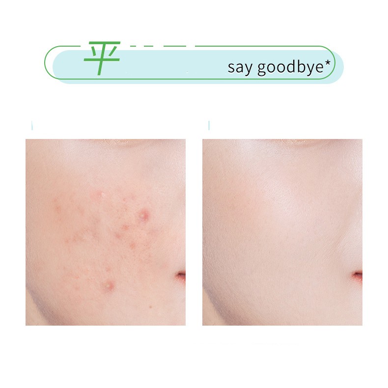 Kem dưỡng làm mờ thâm mụn dàn cho da mụn Acne Cream Maycreate Senabeauty | BigBuy360 - bigbuy360.vn