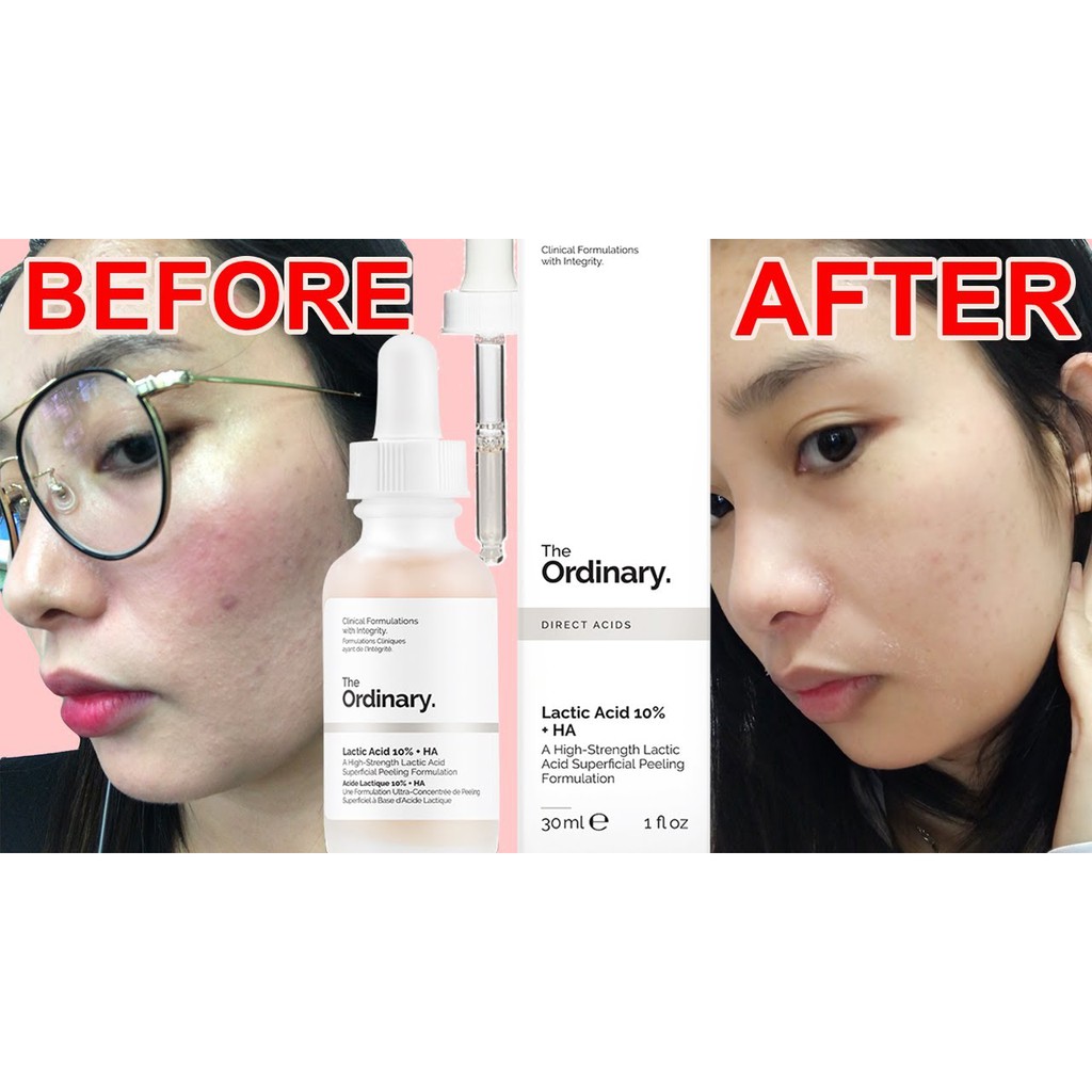 (Bill Canada)Tinh chất Serum Sáng Da Lactic Acid 5% ,10% +HA -The Ordinary