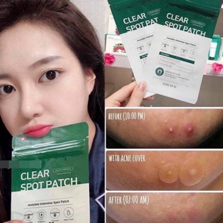 miếng dán mụn some by mi