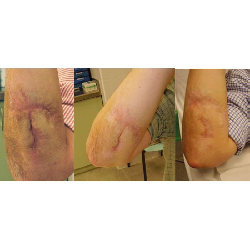 Miếng dán liền sẹo, ép sẹo Mepiform