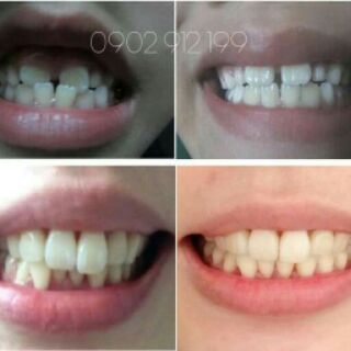 (Lẻ hàm: A1 hoặc A2 hoặc A3) Dụng cụ niềng răng tại nhà