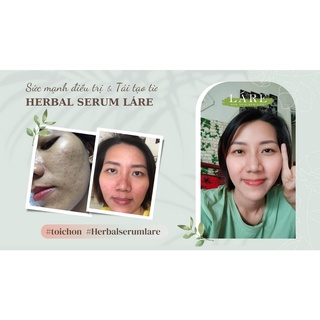 HERBAL SERUM (THANH DƯỢC LÁRE) FULL SIZE 80ML