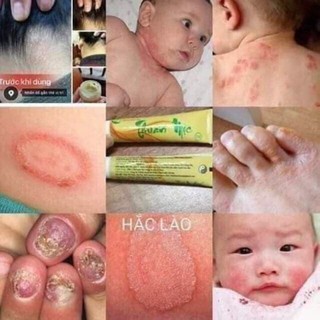 [HÀNG CHÍNH HÃNG] Nấm Ngứa TM