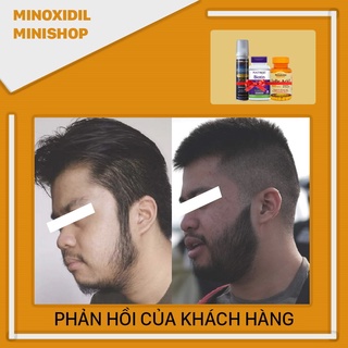 Minoxidil 5% Dạng Bọt Mọc Râu Tóc Combo Biotin Folic