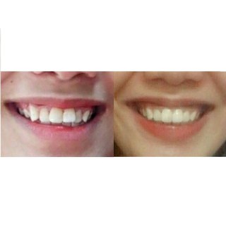 Dụng cụ niềng răng