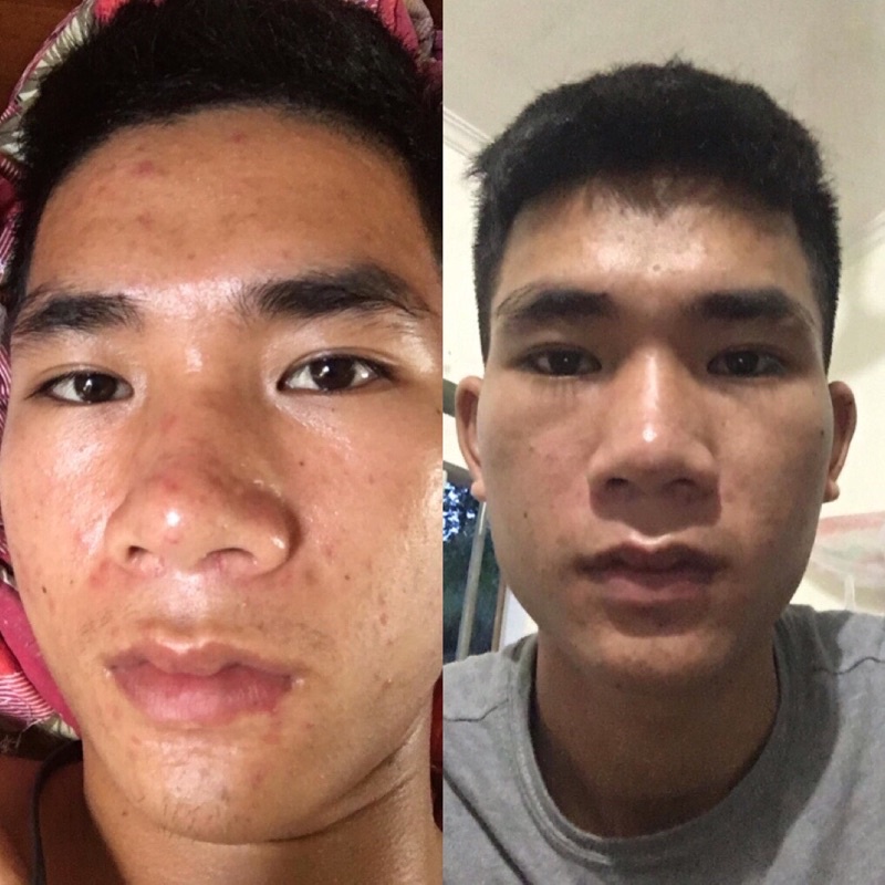 Serum Mộc Beauty Ngừa Mụn