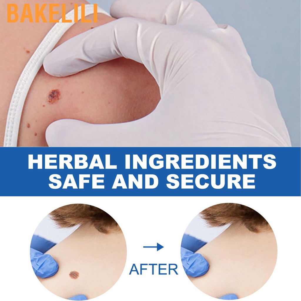 2 tuýp gel loại bỏ mụn thịt 3ml cho mặt và các bộ phận cơ thể