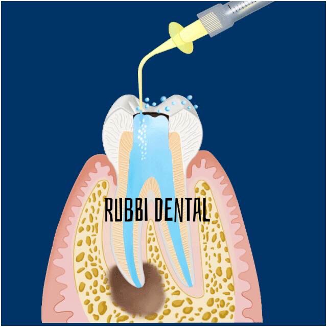 Combo 100 chiếc kim bơm rửa nội nha chống quá chóp 1 lỗ, 2 lỗ dùng trong nha khoa