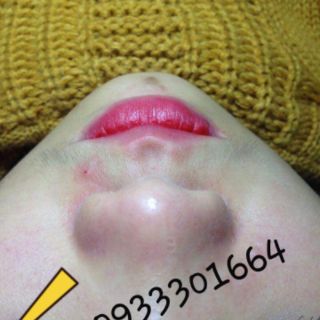 Ủ mụn+ serum se khít