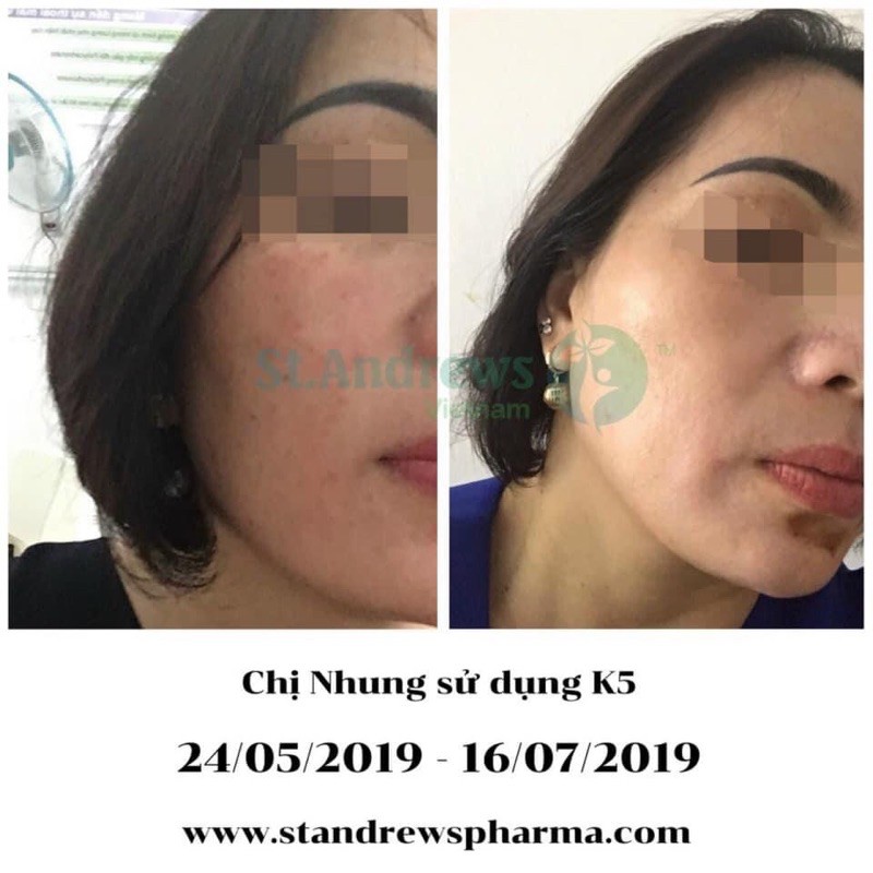 K5 Lipogel - Kem Giảm Nám Chuyên Sâu