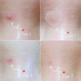 Miếng Dán Mụn Cosrx Acnes Pimple Master Patch