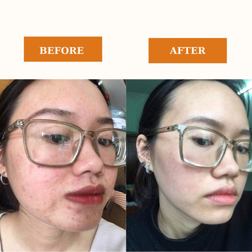 (CHÍNH HÃNG) Megaduo Gel 15g- Giảm Mụn, Giảm Thâm, Giảm Mụn Ẩn | BigBuy360 - bigbuy360.vn