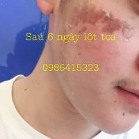 PEEL THAY DA MẶT TCA DÀNH CHO NAM