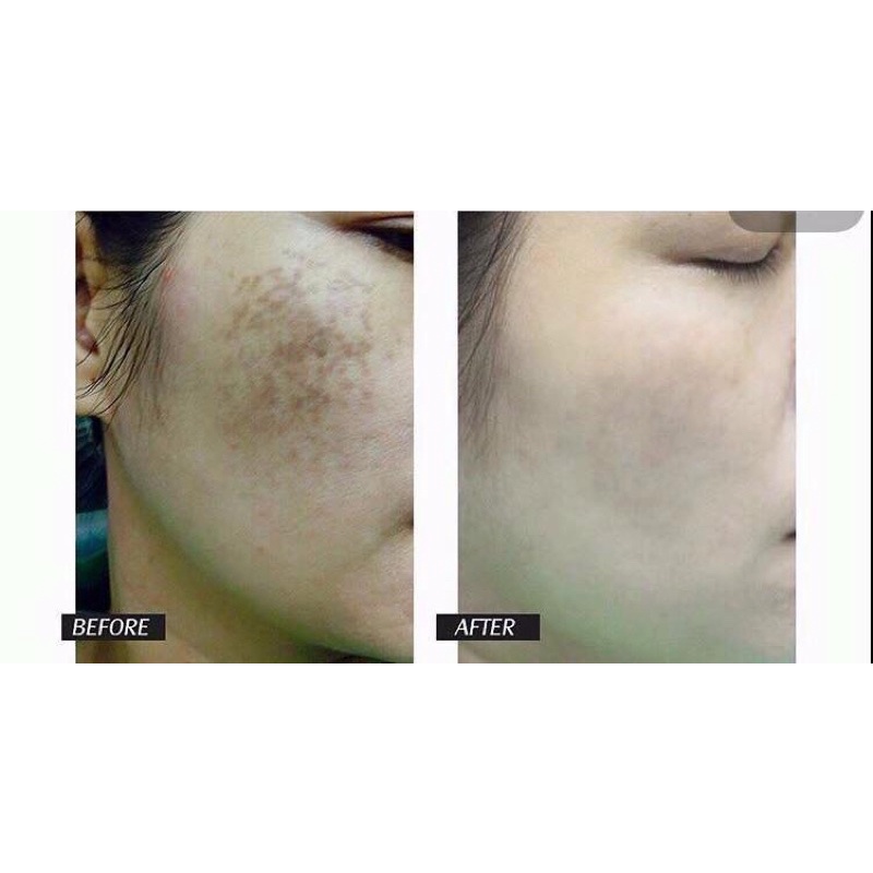 Kem dưỡng trắng mờ nám Royal