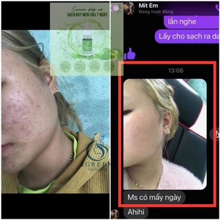 Combo ngừa mụn hoàn hảo từ diếp cá – sữa rửa mặt – serum – mặt nạ - giảm mụn, giảm thâm, se khít lỗ chân lông