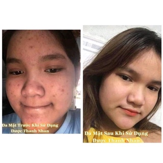 Serum Dược Thanh Nhan (Kèm mặt nạ)