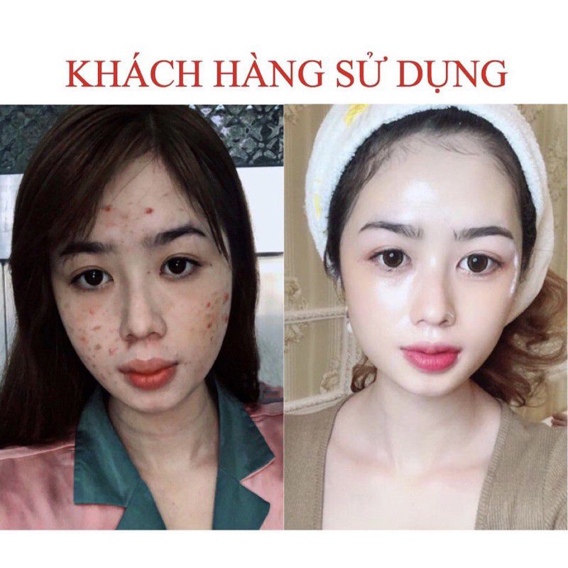 Serum Hoa Thiên Mẫu Giảm Mụn - Hiệu Quả Sau 24h