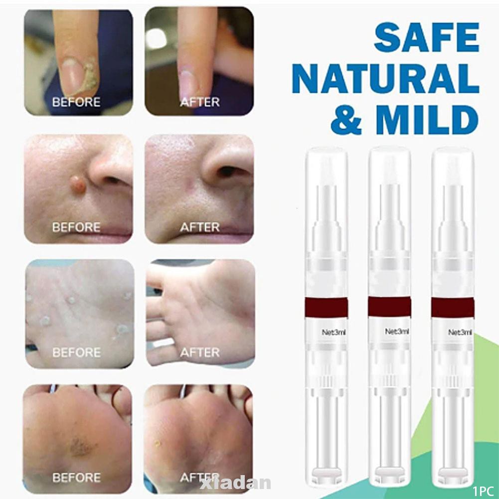 (Hàng Mới Về) Thuốc Trị Mụn Cóc 3ml Chuyên Dụng Cho Gia Đình