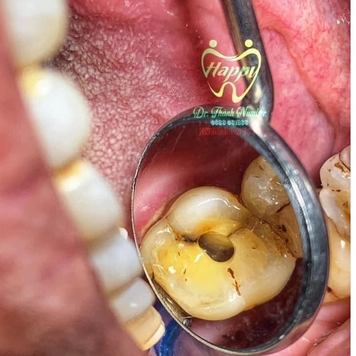 Gương phóng đại nha khoa,mặt gương khám răng