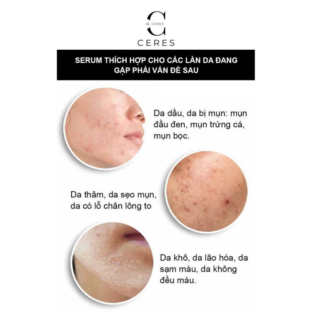 Tinh Chất Niacinamide 10% + Zinc 1% - The Ordinary Serum Giảm Mụn Thu Nhỏ Lỗ Chân Lông