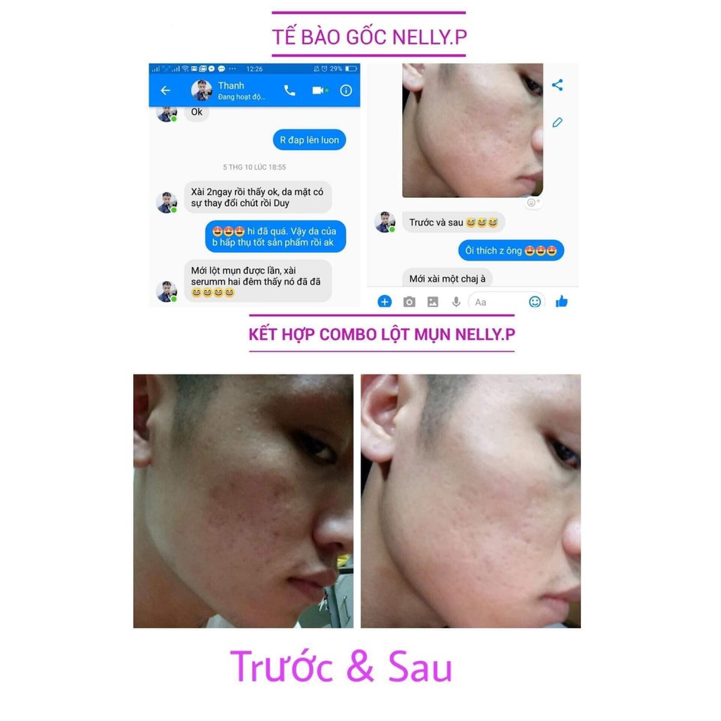 [𝐂𝐨𝐦𝐛𝐨 𝟑 𝐡𝐨̣̂𝐩]Tế bào gốc NellyP -Tinh Chất Serum Hỗ Trợ Giảm Sẹo Lồi - Sẹo Lõm - Sẹo Rỗ Lâu Năm