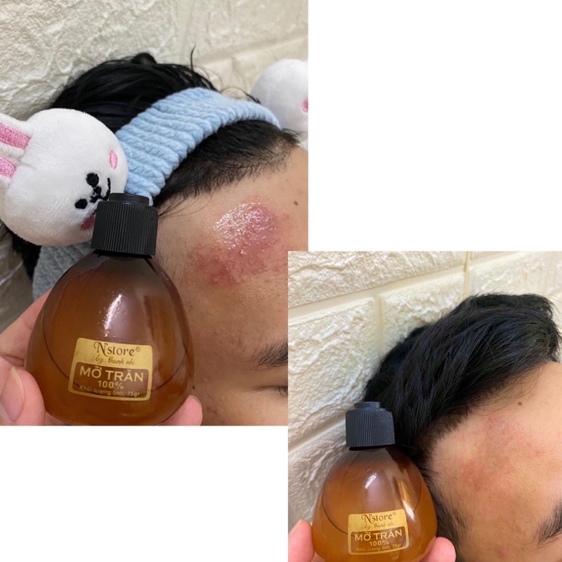 Mỡ trăn nguyên chất 75gr nstore by thanh nhi giúp triệt lông, nhã nắng ,mờ rạn da, mờ thâm nám và mụn,lnpcosmetic