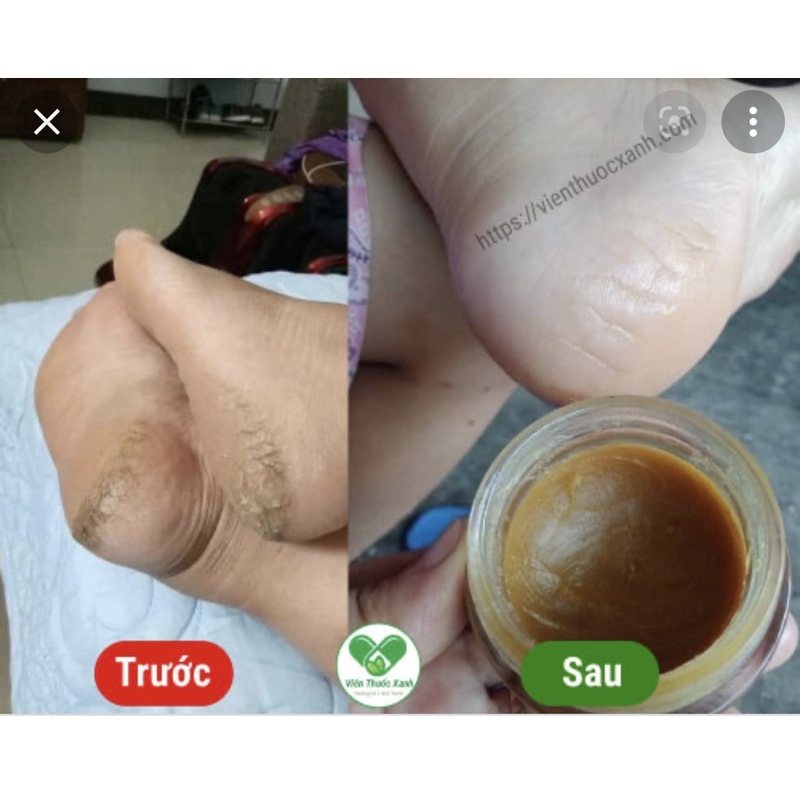 Gel kỳ gót chân nứt kẽ siêu sạch&lt;Hiệu quả lần đầu sử dụng&gt;