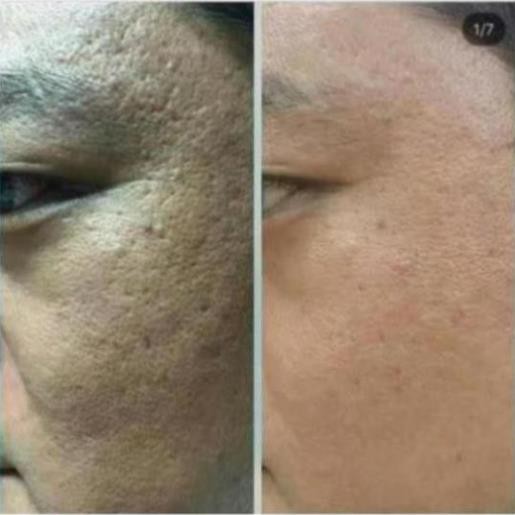 Vi Kim Sinh Học Tái Tạo Da Venus Peel Powder 0.7g ,Venus Peel Serum 5mlx 2 gói - Vi kim tảo biển hàn quốc