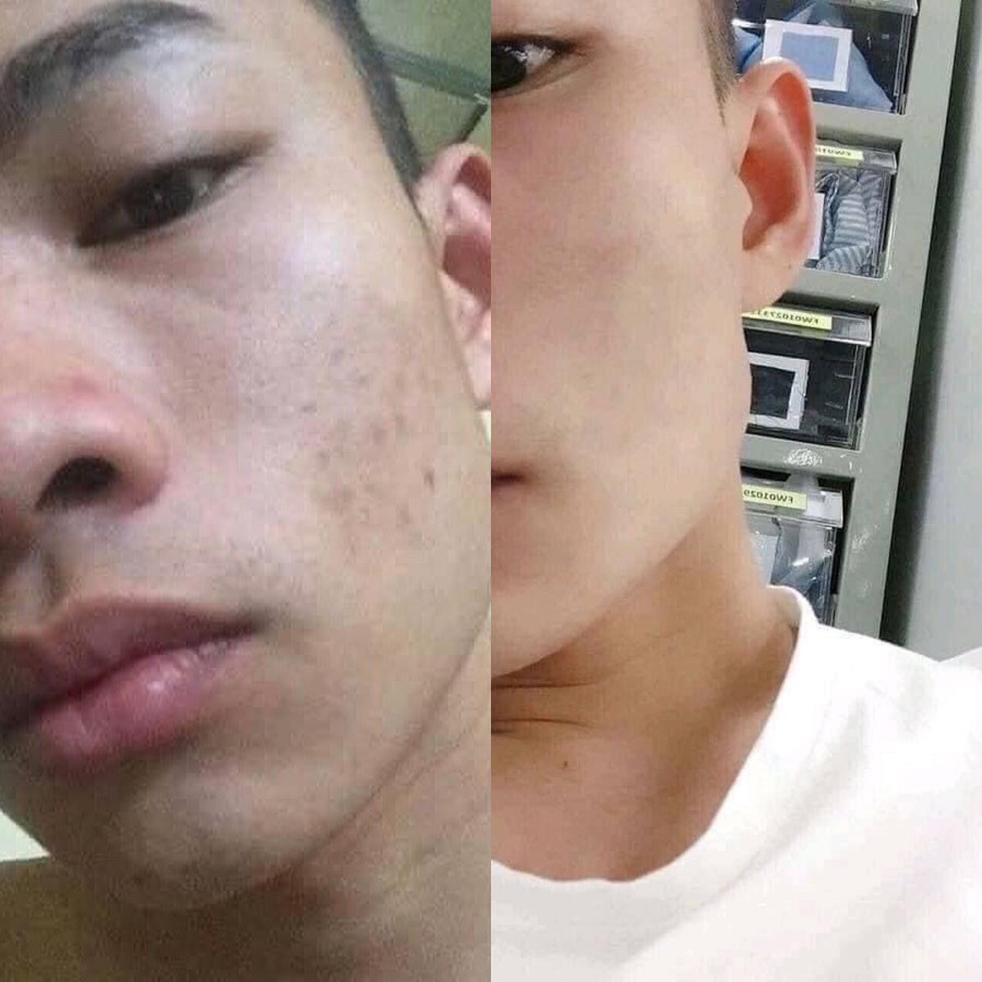Tạm biệt da thô sần sùi chỉ với kem 3Day colagen