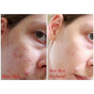 Lotion xẹp mụn Bye Bye Blemish For Acne Drying Lotion