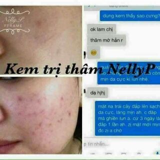 bộ đôi trị mụn và thâm đồng giá nhau