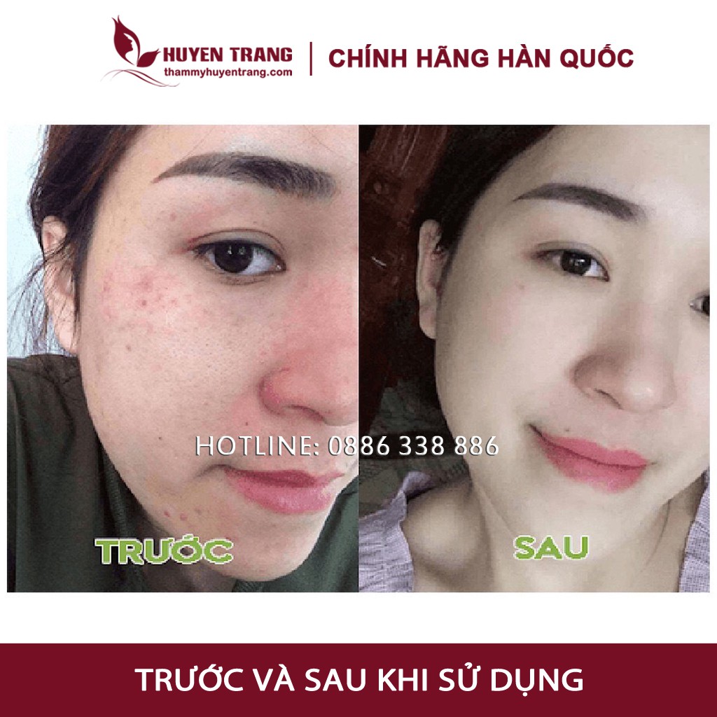 Tế Bào Gốc Hàn Quốc RONAS, serum chăm sóc da, trắng da, se khít, mờ thâm, nám, căng bóng, trẻ hóa da (Tặng nút chiết)