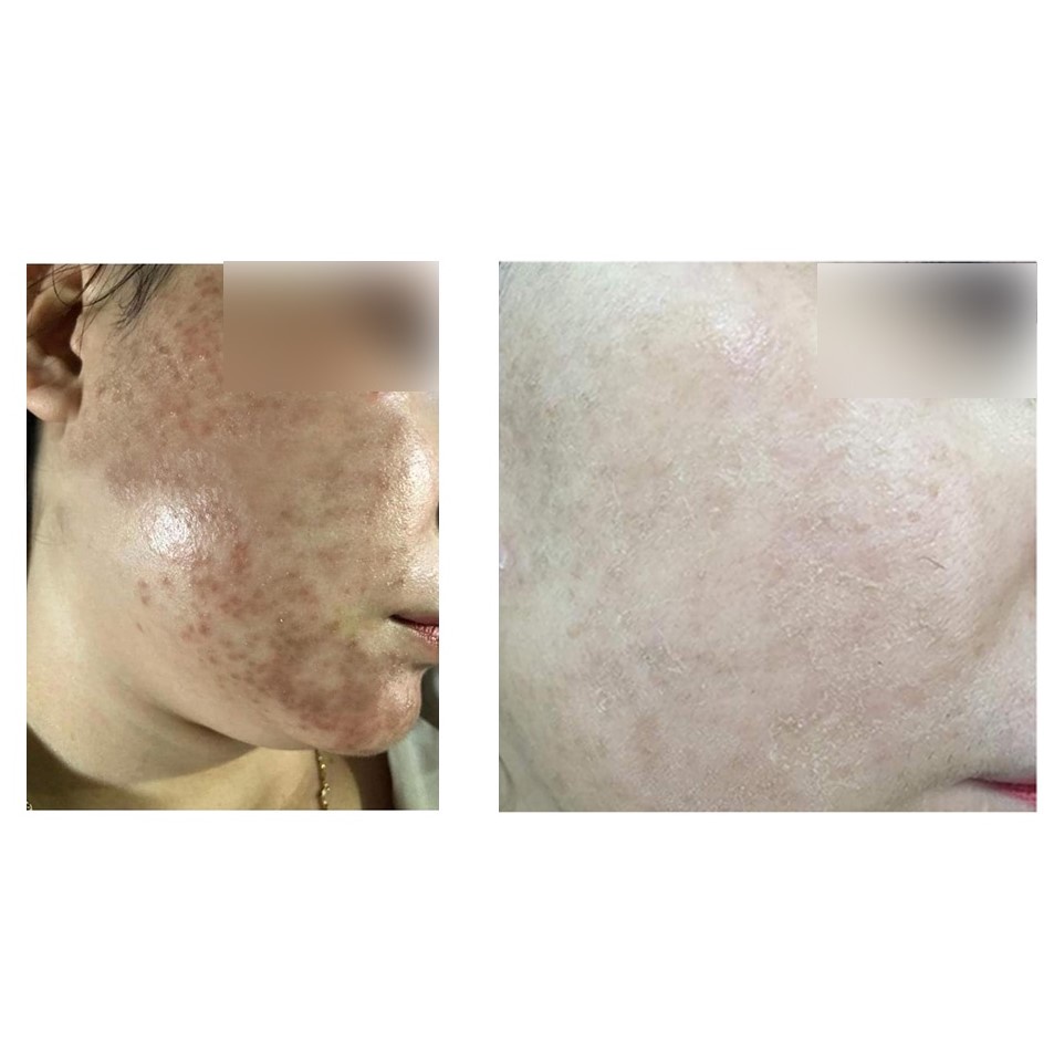 Combo Sạch Mụn Mh Beauty Spa - Noãn Thực Vật, Thần Dược Mh và Cứu Tinh Face 5ml - Sạch Mụn Hiệu Quả