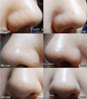 Miếng ủ mụn